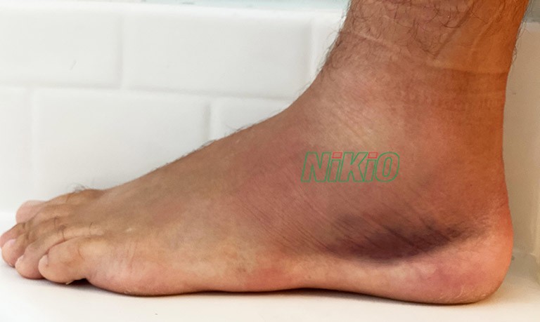 Bị sưng mắt cá chân là do chạy quá nhanh hoặc chuyển động quá đột ngột