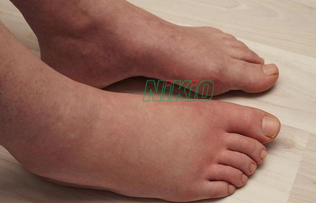 Chân bị phù nề phổ biến và thường thấy nhất ở người cao tuổi 