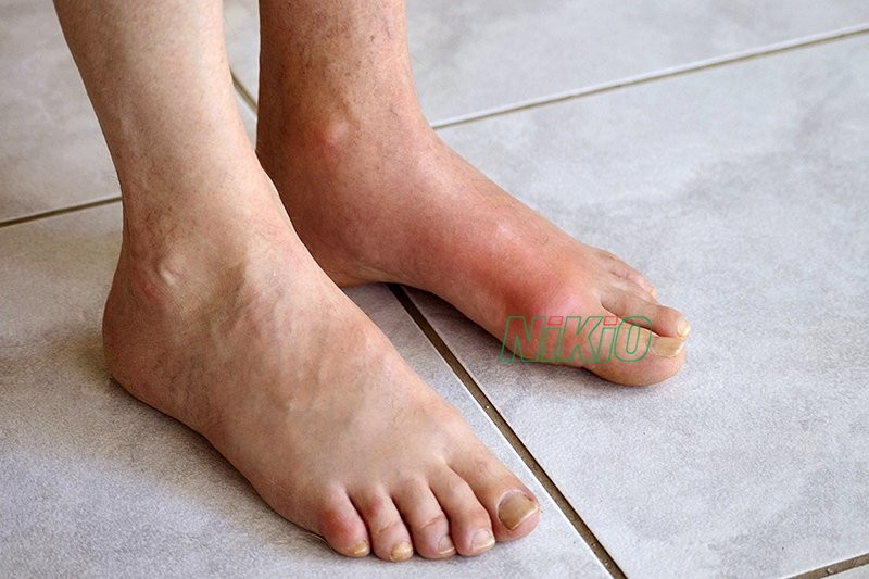 Chân bị sưng phù sẽ gây cản trở sinh hoạt và giảm chất lượng cuộc sống