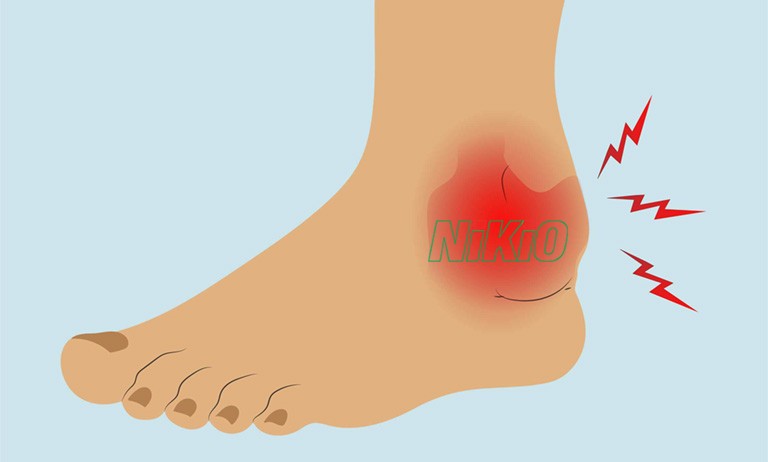 Sưng mắt cá chân sẽ mất thời gian là từ 1 đến 2 tuần để phục hồi 